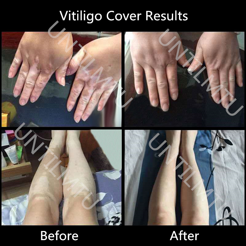 XISHENGYAN Vitiligo Concealer, – White Toner Transfer Paper Bewertung und Preis